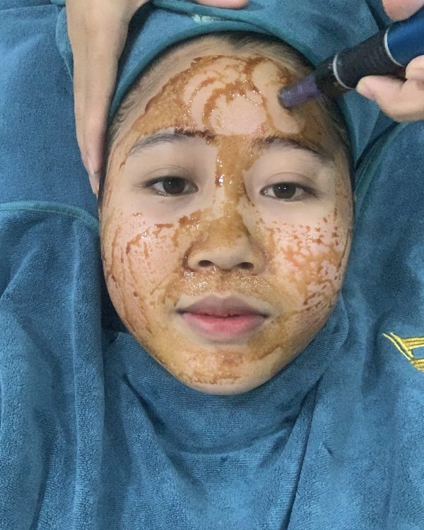 បញ្ចូលវីតាមីនផ្សិត លីងជឺ